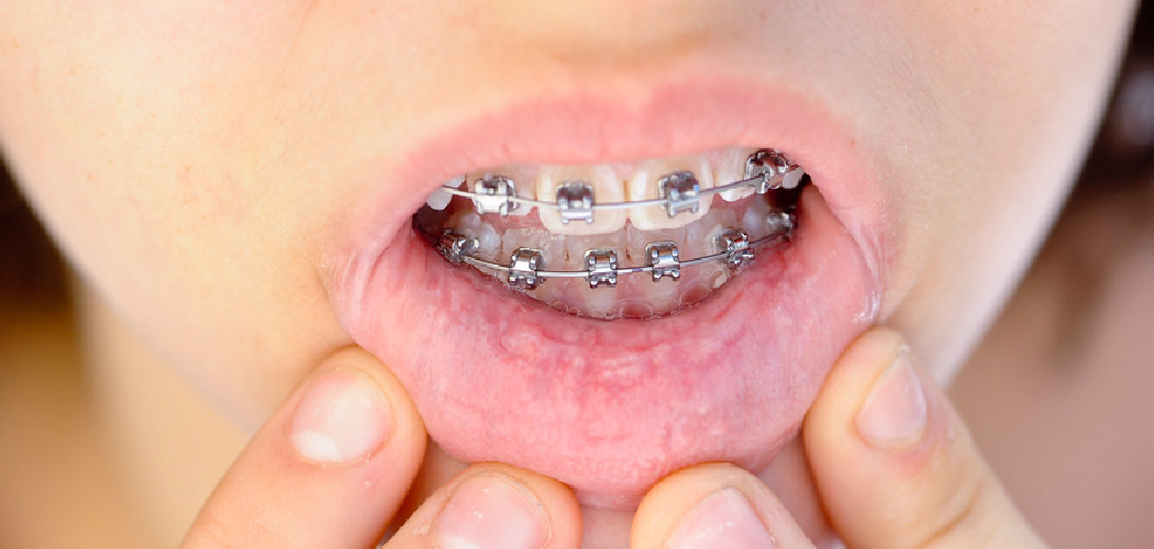 How to Keep Ceramic Braces From Staining